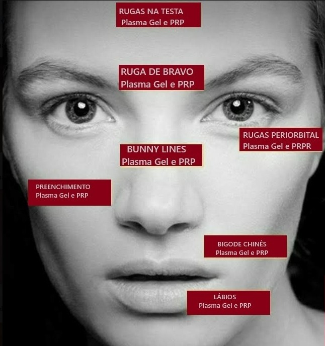 Mapa de áreas faciais frequentemente trabalhadas com Plasma Gel e PRP