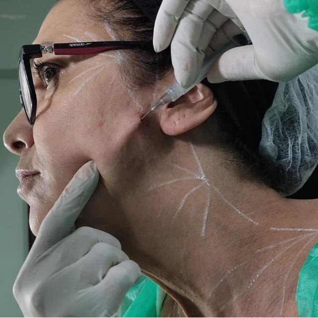 Marcação e aplicação de protocolo facial na Beauty Gene Bio Clinic